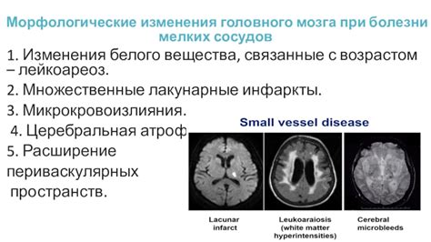 Как распознать дисциркуляторную энцефалопатию?