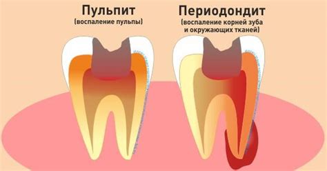 Как распознать хронический зуб