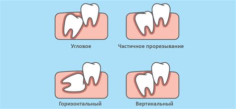 Как решить проблему с поврежденным зубом мудрости?