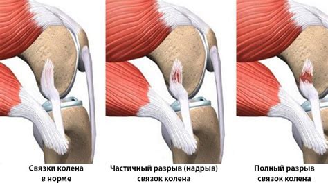 Как тотальный разрыв связки повышает конкурентоспособность