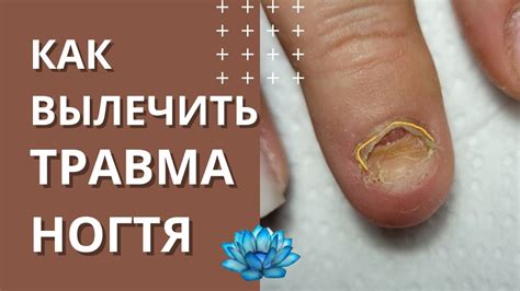 Как удалить пропиленовую ногтевую пластину без вреда для ногтя