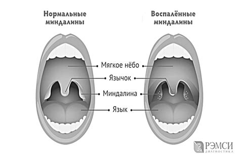 Как узнать, что у вас ангина?