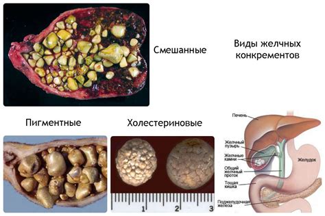 Камни в желчном пузыре – возможный диагноз