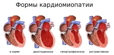 Кардиомиопатия: факторы риска и симптомы