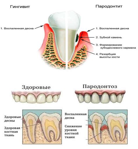 Кариес и пародонтоз: болезни, из-за которых зубы начинают говорить