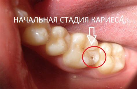 Кариес на зубе: легендарные истории и народные поверья