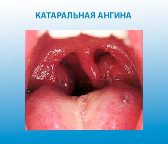 Катаральные заболевания как причина чихания