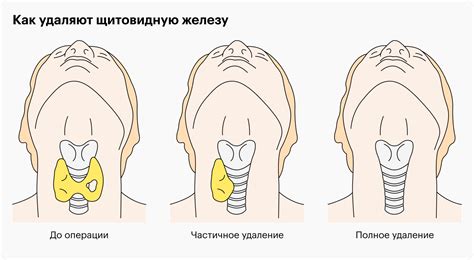 Категория I: бенефицированный папиллярный рак щитовидной железы