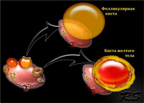 Киста: определение и причины появления