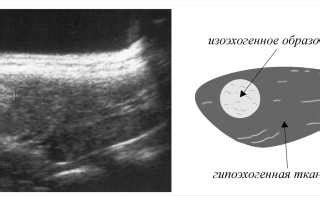 Кисты и гипоэхогенные участки
