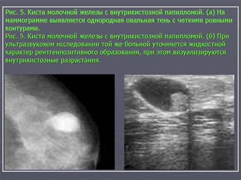 Кисты молочной железы: общая информация