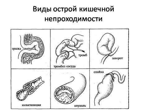 Кишечная непроходимость