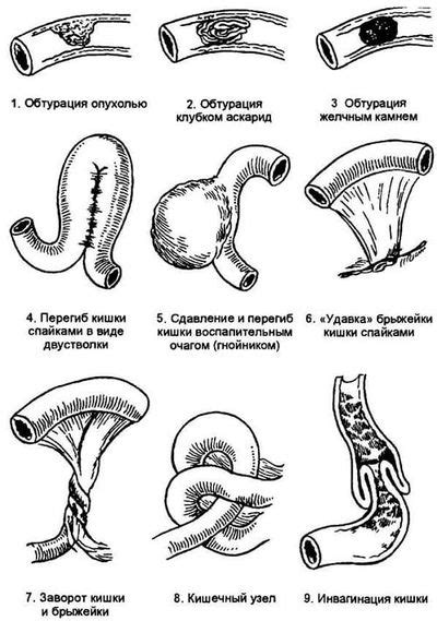 Кишечная непроходимость: признаки и методы диагностики