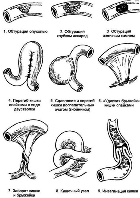 Кишечная непроходимость у взрослого: