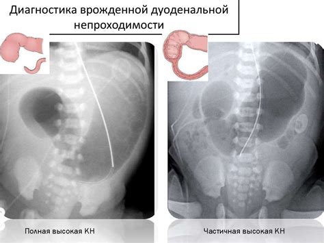 Кишечная непроходимость у новорожденных