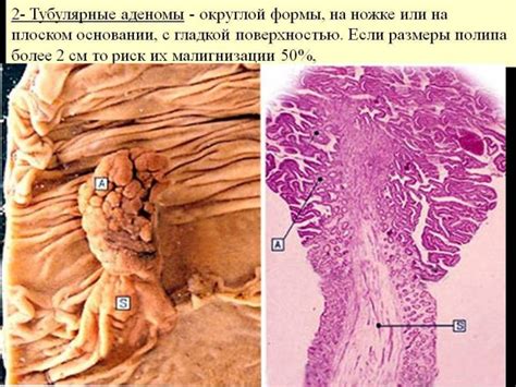 Классификация аденомы кишечника