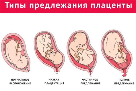 Классификация зрелости плаценты