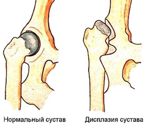 Классификация и типы дисплазии