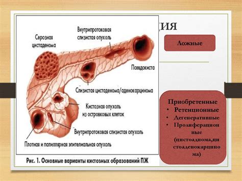 Классификация кисты желудка