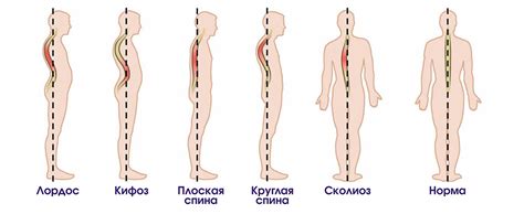 Классификация сифозных деформаций