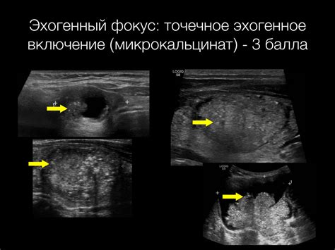 Классификация эхогенных участков