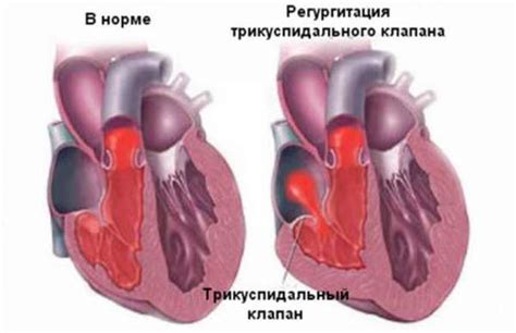 Клинические проявления и диагностика дисфункции трикуспидального клапана