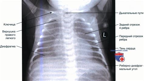 Ключевые показатели декодирования рентгеновских снимков грудной клетки у ребенка