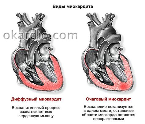 Когда незначительные изменения миокарда могут быть опасными?