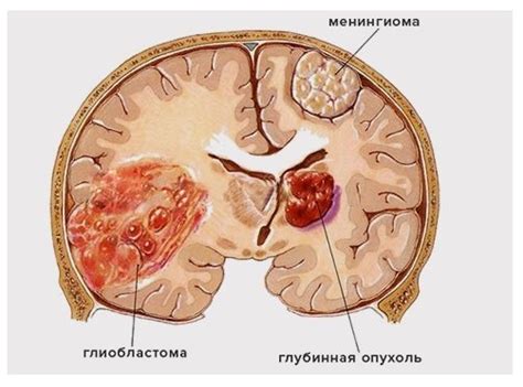 Когда нужна операция: глиобластома способна постепенно расти