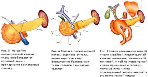 Когда показано хирургическое лечение сорвавшейся поджелудочной?