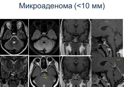 Когда рекомендуется проведение МРТ гипофиза?