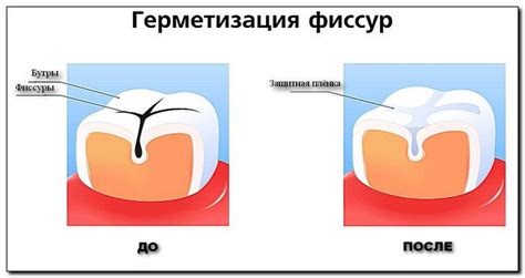 Когда следует начинать герметизацию фиссур