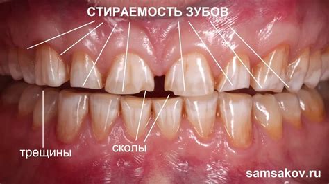 Когда сон о потере зубов может быть связан с проблемами здоровья и требовать вмешательства врача