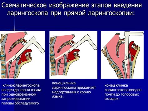 Когда требуется непрямая ларингоскопия?