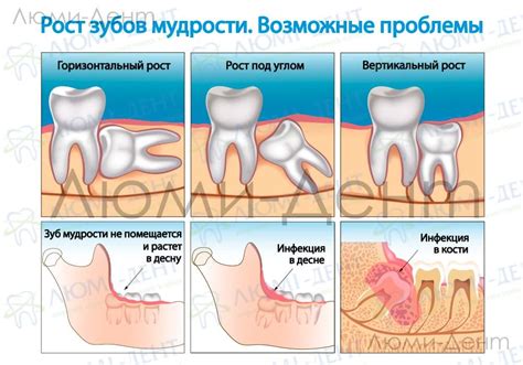 Колоритные сны: скрытый смысл выдирания зуба мудрости в ночных видениях