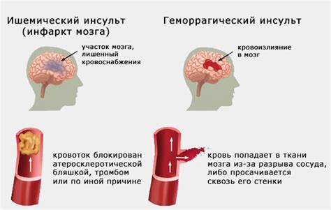 Кома после инсульта: причины, симптомы, последствия