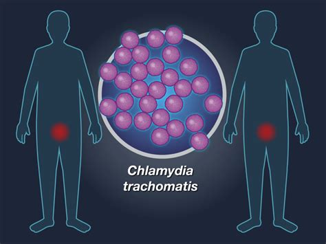 Комбинированная терапия chlamydia trachomatis