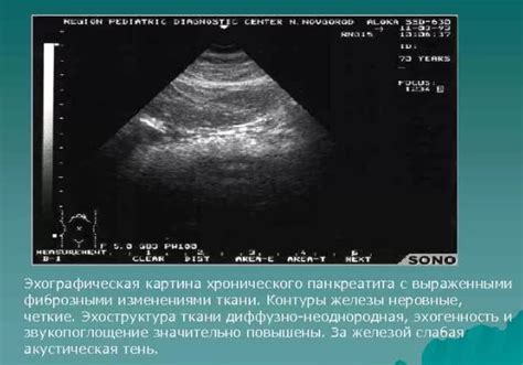 Комплексная диагностика и мониторинг повышенной эхогенности при узи поджелудочной железы