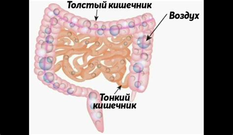 Компликации выраженной пневматизации кишечника