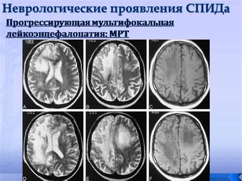 Компликации сосудистой лейкоэнцефалопатии