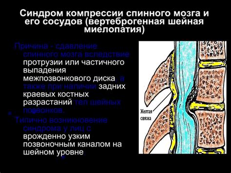 Компрессионные синдромы