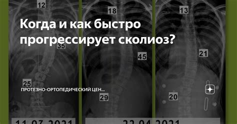 Кому угрожает сколиоз и как заболевание прогрессирует