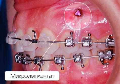 Конвертируемые замки для брекетов