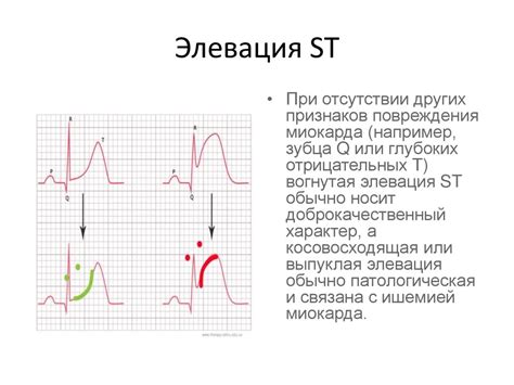 Конкордантный подъем сегмента ST: его значение в диагностике