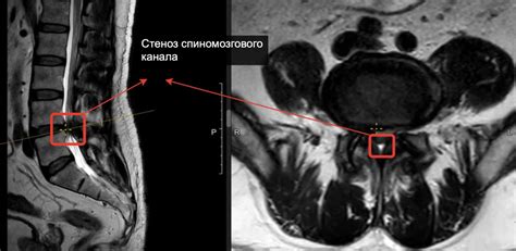 Консервативное лечение анатомической узости позвоночного канала