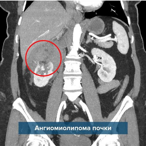 Консервативное лечение ангиомиолипомы правой почки