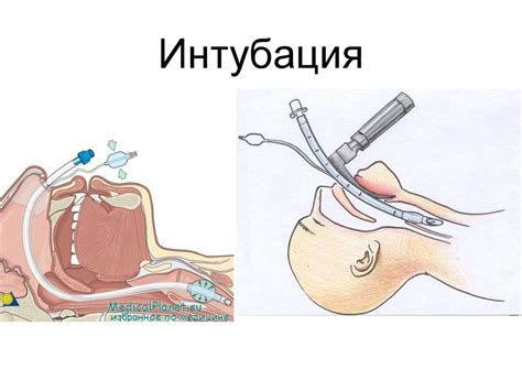 Контроль и поддержание интубации