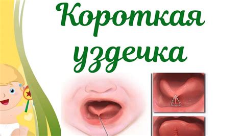 Короткая уздечка языка у ребенка