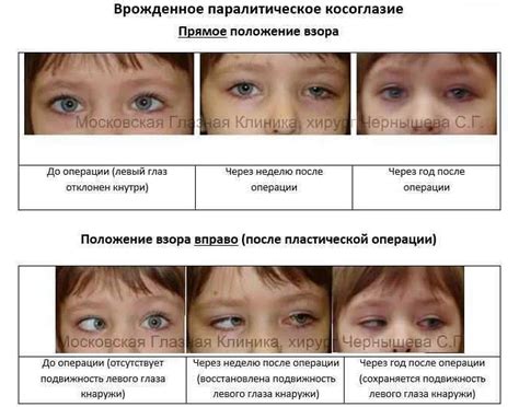 Косоглазие и его последствия