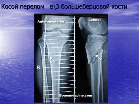 Косой перелом: особенности и диагностика